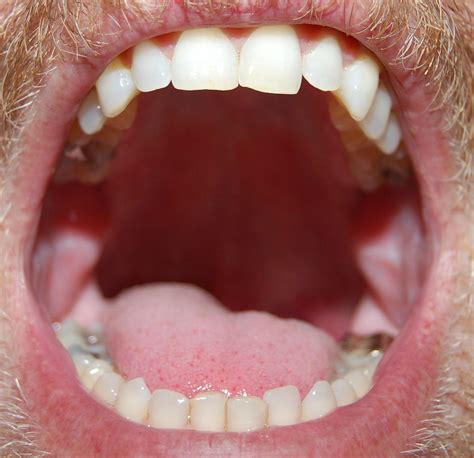 Wide Open Mouth Revealing Teeth Tongue Palate And Uvula