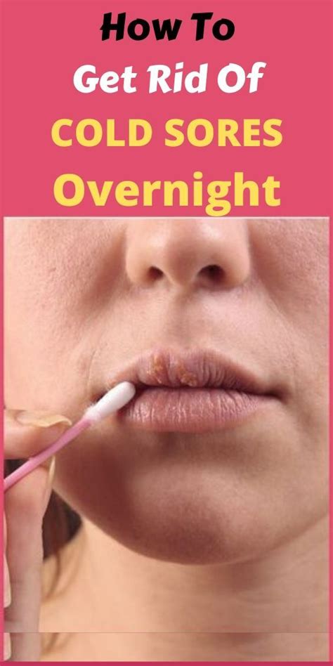 How To Get Rid Of Cold Sores Overnight In 2020 Cold Sore Get Rid Of