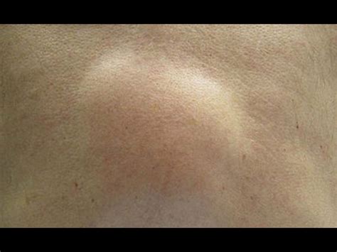 What Causes Armpit Lumps These Cysts And Bumps Can Be Painful Small Or Big Download Free