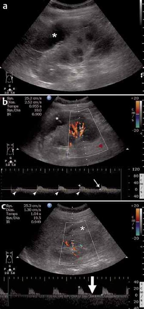 Sagittal A B Mode And B Color And Pulsed Wave Doppler Ultrasound Us