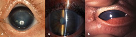 Glaucoma Information Congenital Glaucoma Glaucoma Information