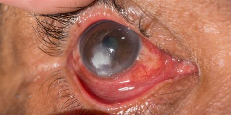 Symptoms ulcers of the eye are very painful and your cat may paw at his or her eye. Eye Center of Virginia - Williamsburg: Corneal Ulcer Treatment