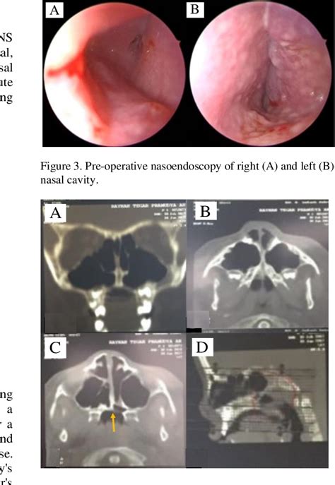 Paranasal Sinuses Ct Scan Coronal A Axial B C Download