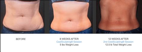 Image Gallery Coolsculpting Results The Contour Day Spa