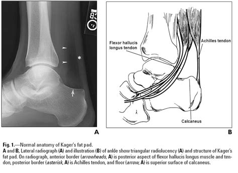 Calcaneal Fractures Wikiradiography