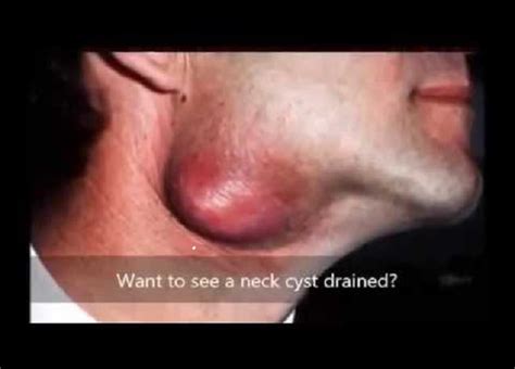Cyst Removal From Neck