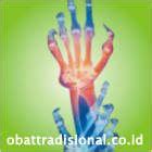 Tulang kaki berbentuk huruf x atau o diakibatkan oleh. Rematik, Penyakit Rematik, Gejala Rematik