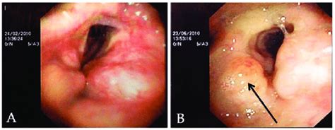 A Fiber Laryngoscopic Image Revealing Swollen Laryngeal Ventricles