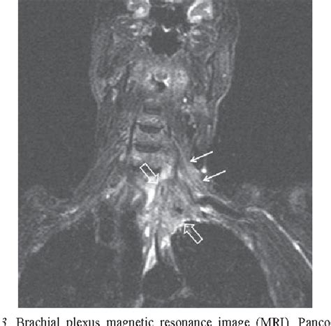 Figure 3 From Neoplastic Brachial Plexopathy Detected By