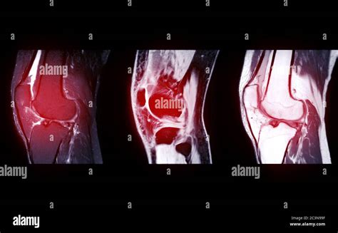 Compare Of Mri Knee Joint Or Magnetic Resonance Imaging Sagital View