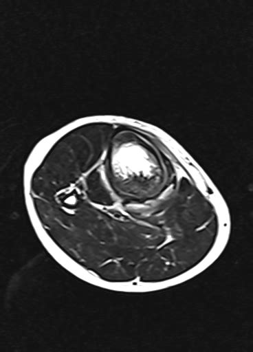 Osteoblastoma Image