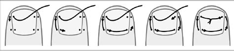 Figure 1 From Non Operative Treatment Versus Suture Refixation Of The