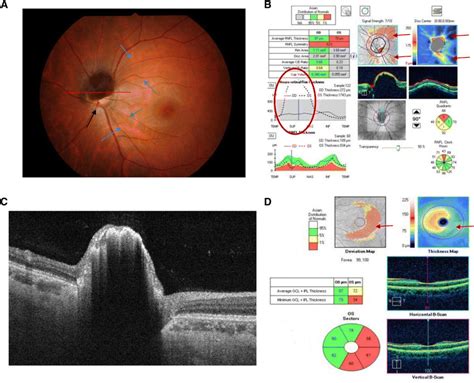 Fundus Photograph A Optical Coherence Tomography Findings Bd And