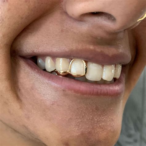 Open Face Gold Crown Tooth Ubicaciondepersonascdmxgobmx