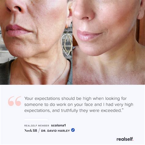 How A Neck Lift Is Done And How Long It Lasts Artofit