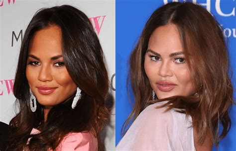 Chrissy Teigen Plastic Surgery Before And After