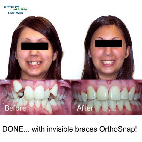 Pin By Berthelga Pinehogger On Braces Clear Braces Invisible Braces Straighten Teeth Without