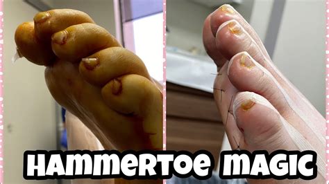 Minimally Invasive Hammertoe Surgery Live Procedures 😍 Youtube