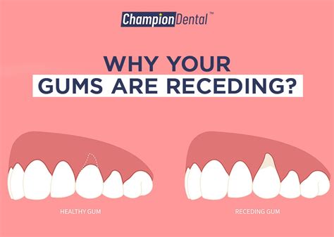 Why Your Gums Are Receding Champion Dental