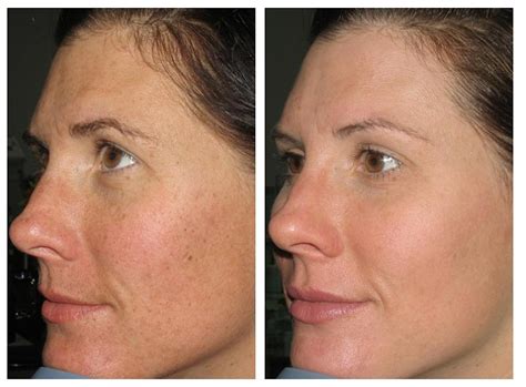 Before And After Renova Laser Hair Removal And Medspa