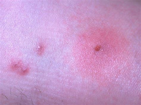 Bed Bug Rash 3 Signs You Might Have Bed Bugs