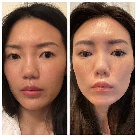 Before After Photos Of Non Surgical Facial Rejuvenation Contouring With
