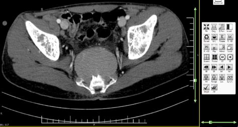 Contrast Enhanced Abdominopelvic Computed Tomography Ct Scan There Is