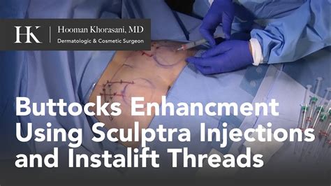How To Perform A Buttocks Lift Using Sculptra And Threads By Dr