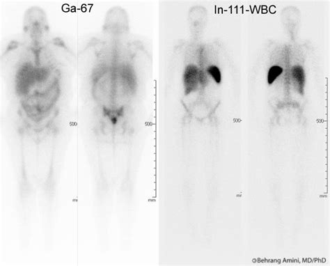 Roentgen Ray Reader Ga Citrate Vs In Wbc