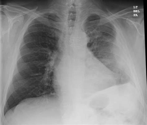 The loculated effusion located along the expected course of the fissure is well defined and elliptical, with pointed margins. Image-guided drainage of intrathoracic air and fluid ...