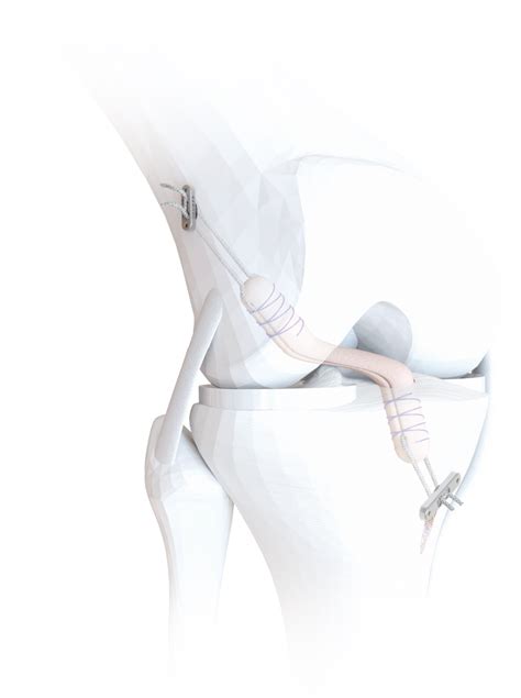 Sbm Anterior Cruciate Ligament Reconstruction