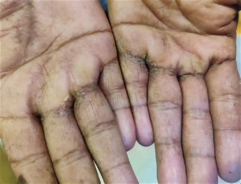Hyperkeratotic Hand Dermatitis Sexiz Pix Sexiz Pix