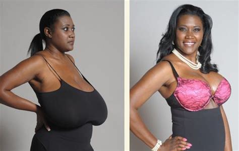 Breast Reduction Surgery Utopia Plastic Surgery And Med Spa