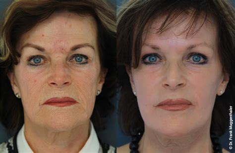 Botox® ist nicht immer gleich botox®. Vorher Nachher Bilder Facelift, Phenol Peeling ...