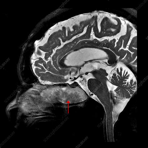 Inverted Papilloma MRI Stock Image C027 1824 Science Photo Library