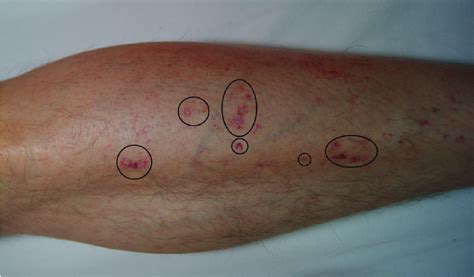 Petechiae Rashes On Lower Leg