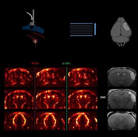 4d Transcranial Ultrasensitive Doppler Imaging To Monitor Cerebral