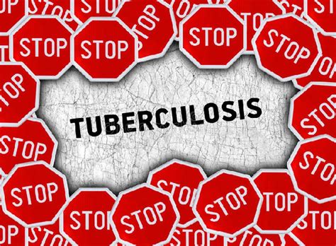 This month, the united nations general assembly will hold the first. 'Deadly' XDR Tuberculosis kills one in Ghana - Prime News ...