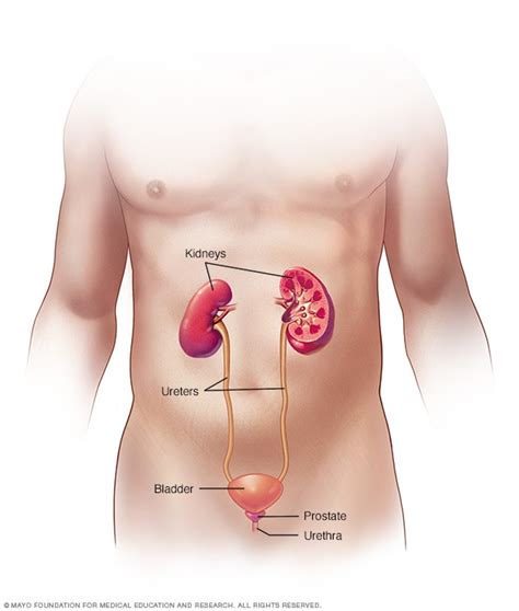 Involving both sides of the body unilateral: Kidney stones - Symptoms and causes - Mayo Clinic