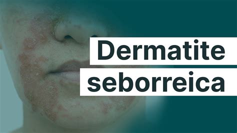 Medicina Na Vida Real Dermatite Seborreica Promedicina Youtube