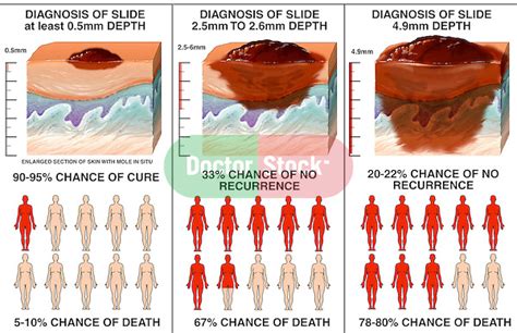 This means you have a cancerous tumor that's less than 2 millimeters thick. Progression of Melanoma | Doctor Stock