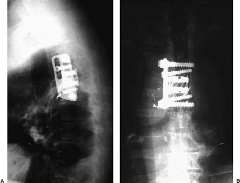 Thoracoscopic Management Of Spinal Tumors Neupsy Key