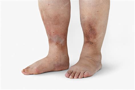 Premium Photo Inflamed Legs Of A Woman With Diabetes Closeup