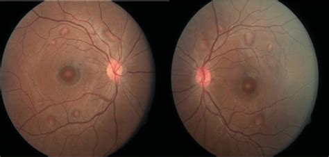 Fundoscopic Exam Showing Multi Foci Serous Retinal Detachments