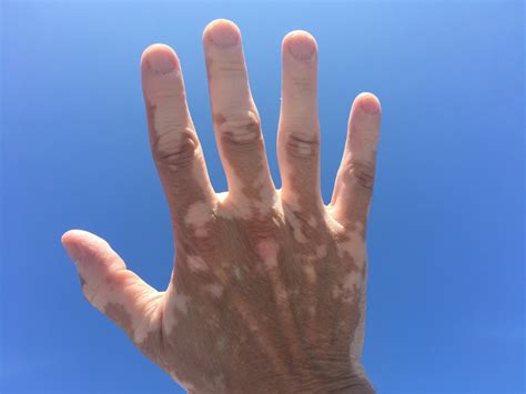 The Story Of An Indian Doctor With Vitiligo