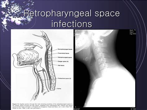 Ppt Deep Neck Infections Powerpoint Presentation Free Download Id