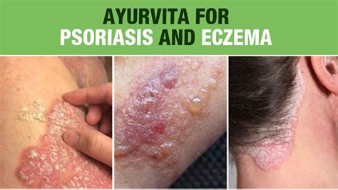 Symptoms Of Psoriasis And Eczema Dr Vijay Kushvaha Ayurvita Youtube