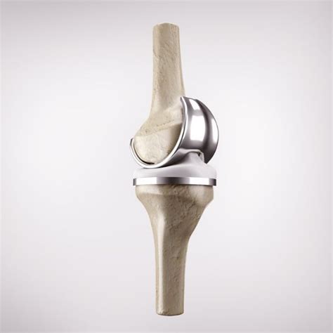 Total Knee Replacement Computer Guided Knee Surgeon South Windsor