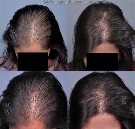 I am 27 with female patterned hair loss worsening the past 2 years. Female hair transplant surgery before and after result ...