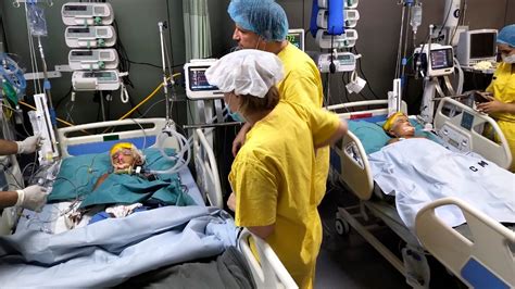 Twins Born Conjoined At The Head Are Separated Successfully The New